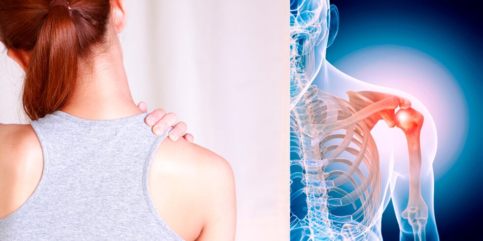 Le développement de l'arthrose de l'épaule entraîne progressivement une douleur constante. 