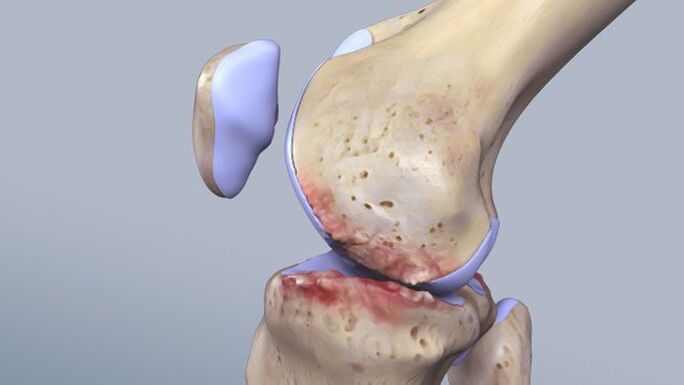 La structure de l'articulation du genou affectée par la pathologie. 