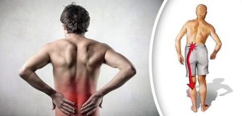 Le syndrome de la douleur avec l'ostéochondose lombaire rayonne sur les jambes