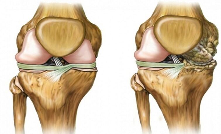 Sain et affecté par l'arthrose articulaire