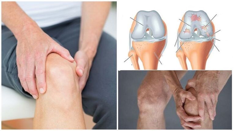 Symptôme de l'arthrose peinture au genou de l'articulation du genou