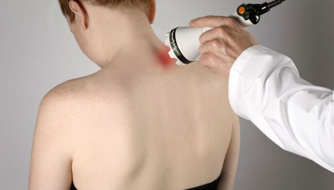 Thérapie au laser pour l'ostéochondrose cervicale.