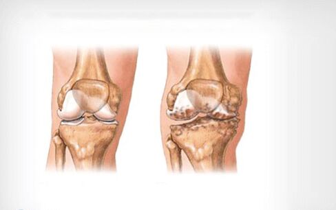 arthrose de l'articulation du genou