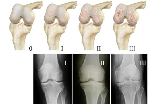 méthodes pour diagnostiquer l'arthrose du genou